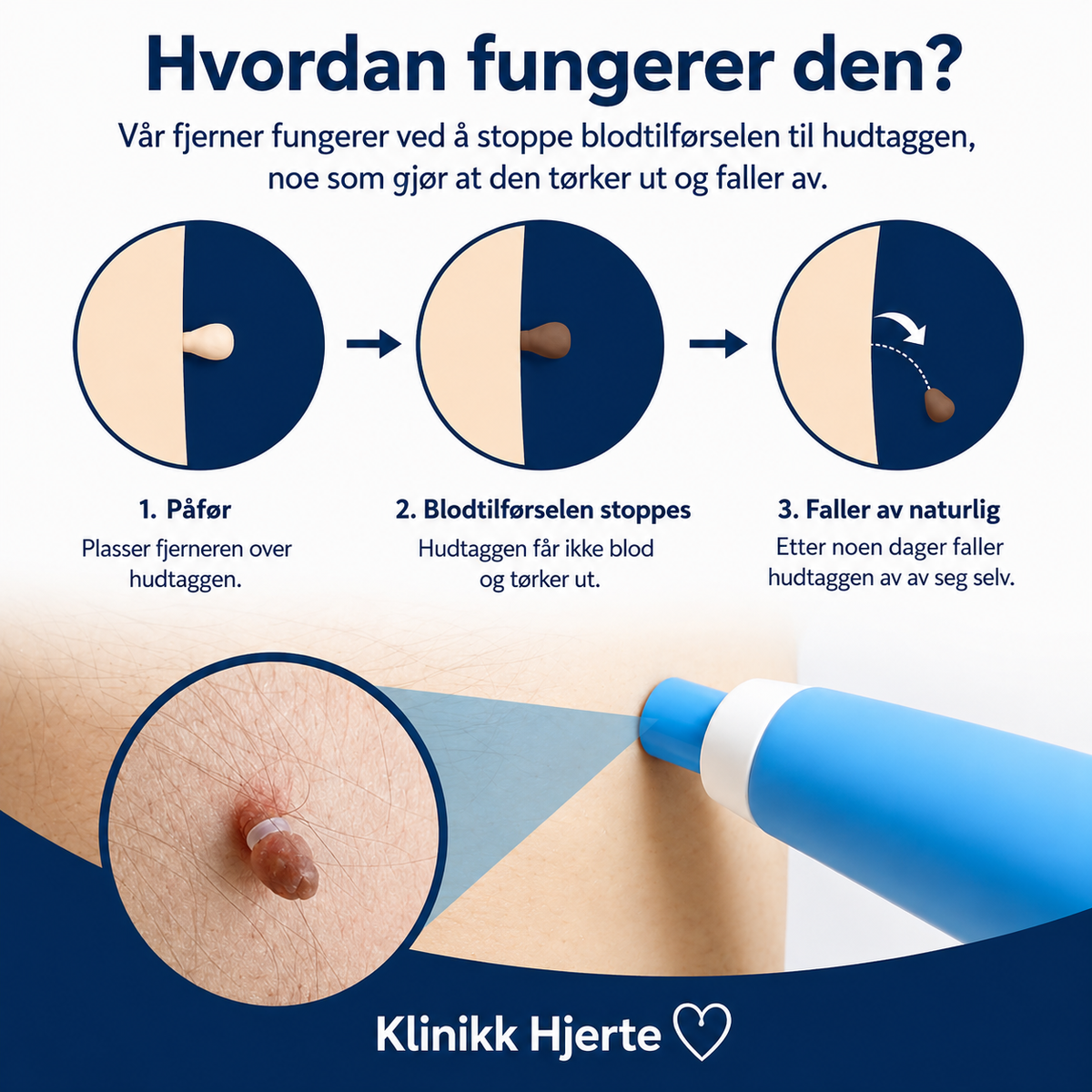 Hudflikfjerner for hjemmebruk – komplett sett for målrettet påføring