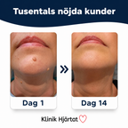 Hudflikfjerner for hjemmebruk – komplett sett for målrettet påføring