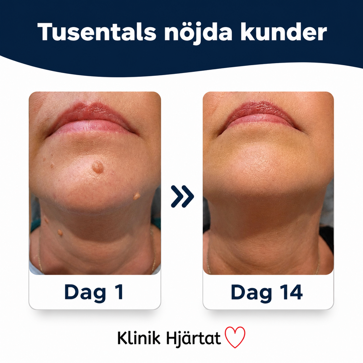 Hudflikfjerner for hjemmebruk – komplett sett for målrettet påføring