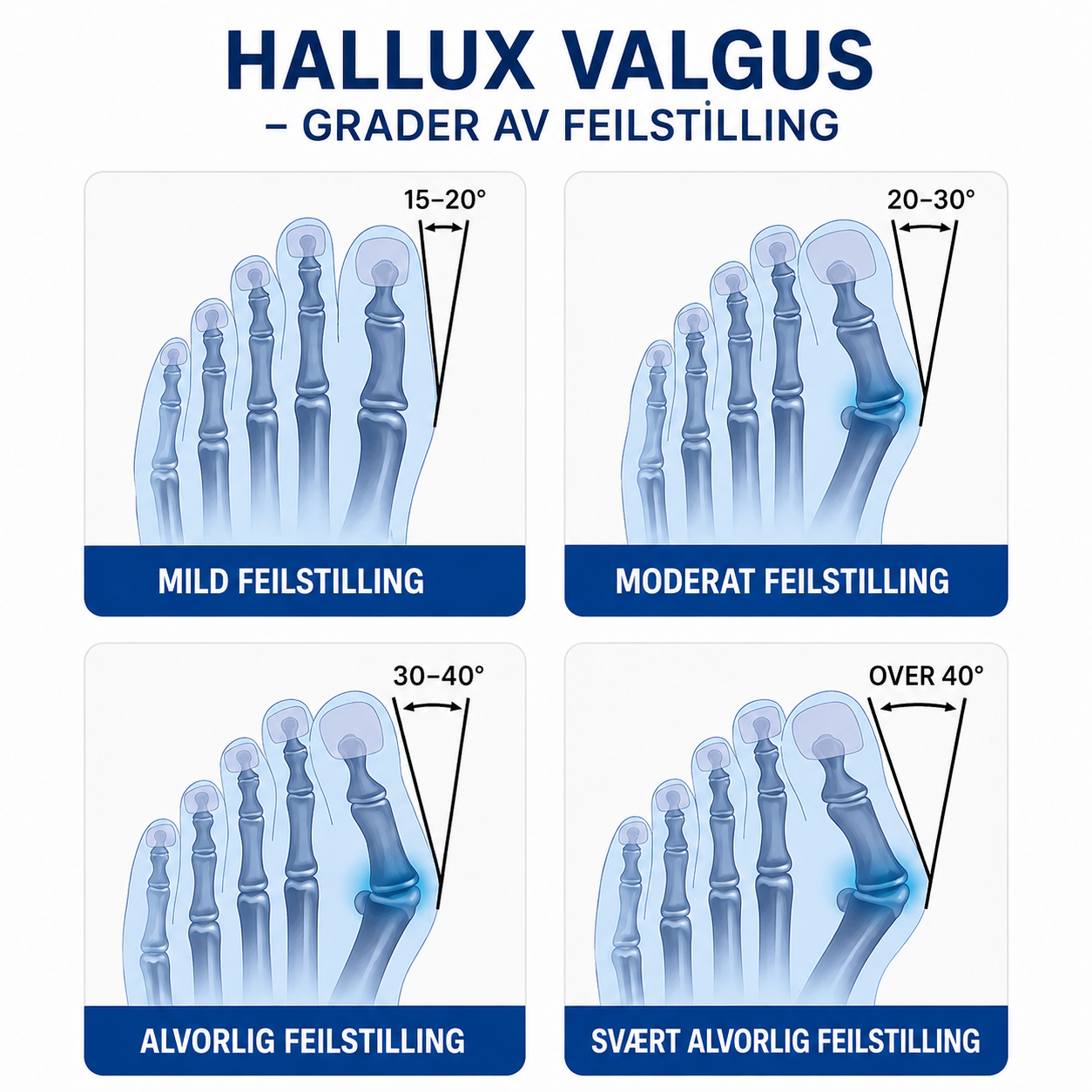 Tåskiller og fotstøtte for hallux valgus